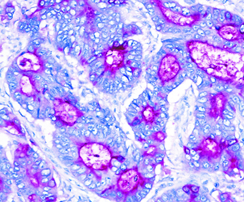 Carcioembryonic Antigen (CEA) 1,0mL