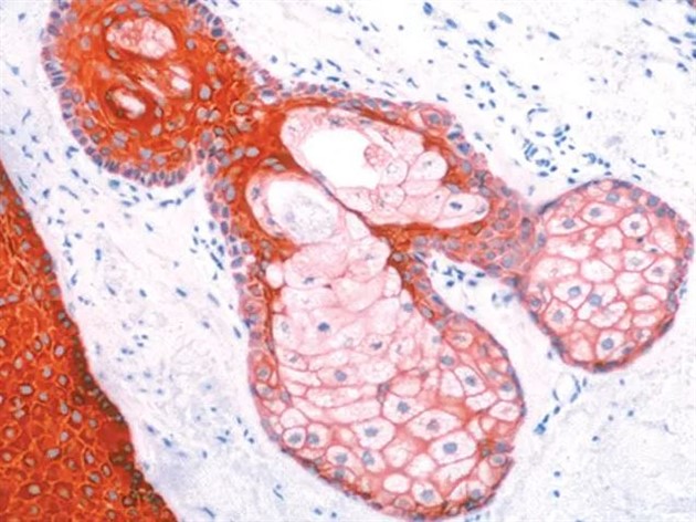 Pan Cytokeratin Plus [AE1/AE3+8/18]