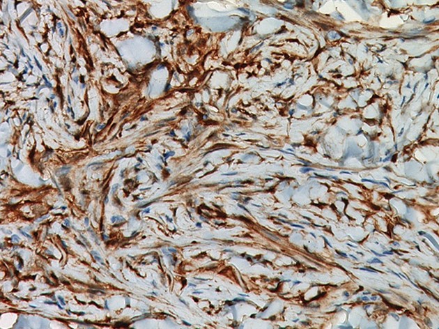 Factor XIIIa 6,0 ml RTU