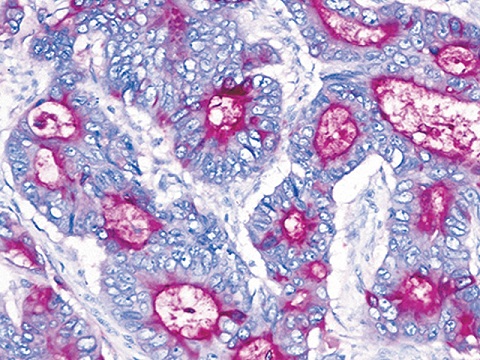 Carcioembryonic Antigen (CEA) 0,5mL