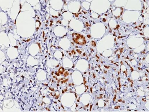 Progesterone Recptor (PR) [PgR636] 7,0 ml